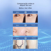Beauty Laser Pen for Mole and Spot Removal Frugal Finds Galore
