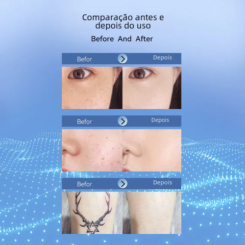 Beauty Laser Pen for Mole and Spot Removal Frugal Finds Galore