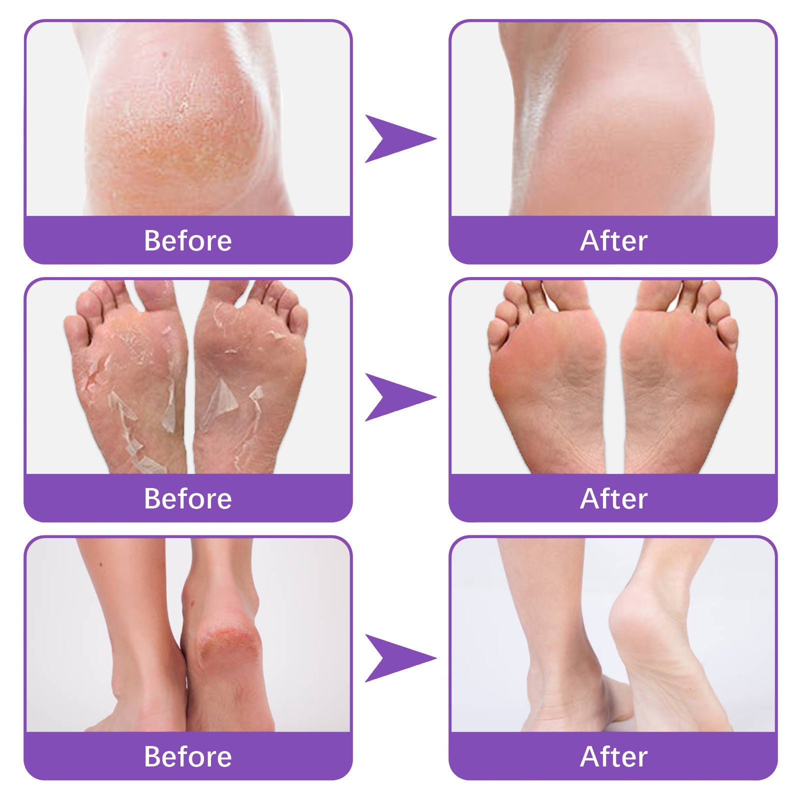 Exfoliating  Foot Mask